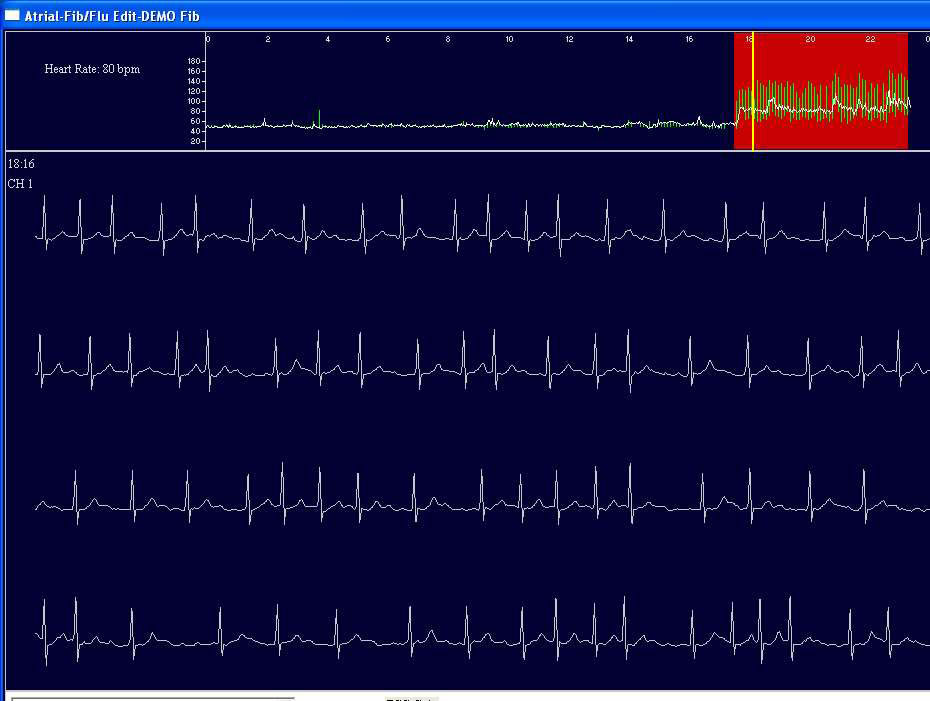 Fibrilación atrial