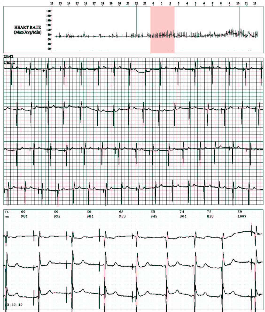 Fibrilación atrial